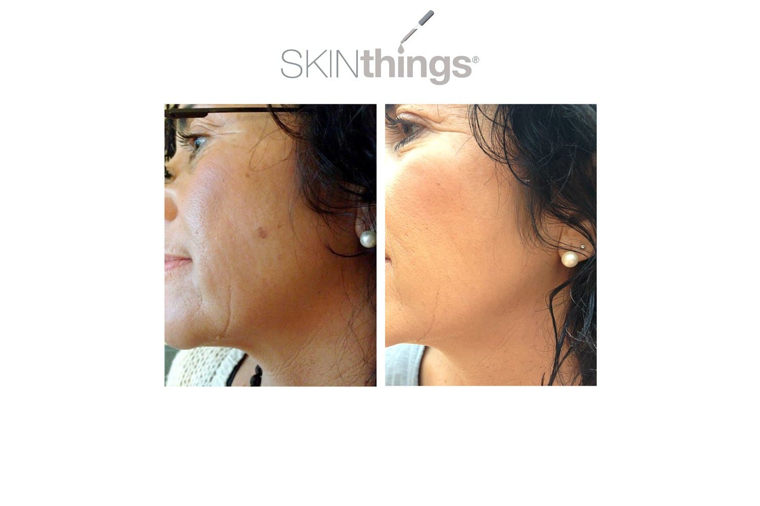SKINthings Freezer (Cryo) at Magic Beauty, Almancil